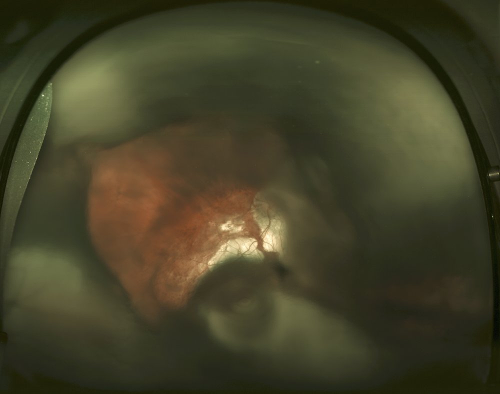 Choroidal Detachment 2 Ophthalmology GRathert Images Choroidal Detachment 2 Ophthalmology GRathert Images