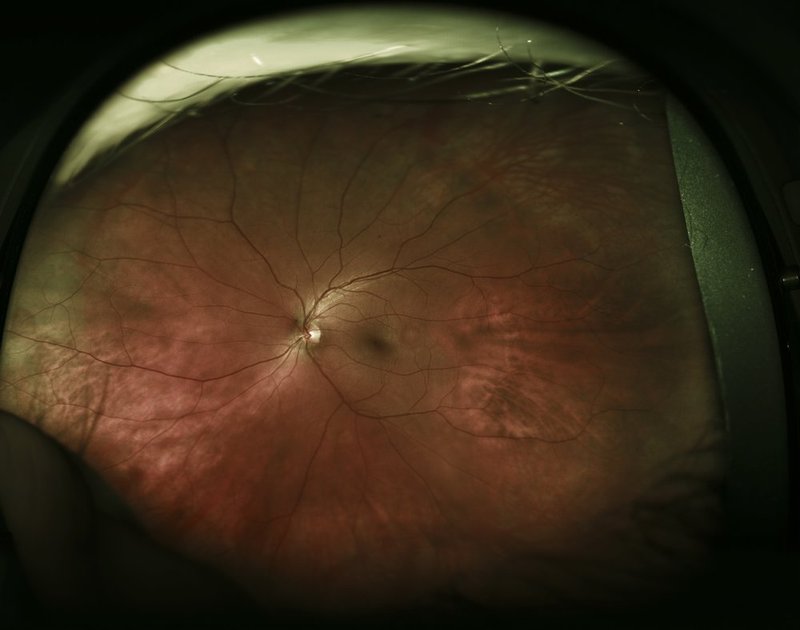 Central Serous Retinopathy.jpg