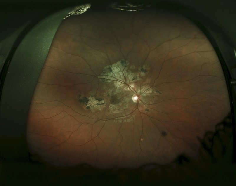Chorioretinitis scar.jpg