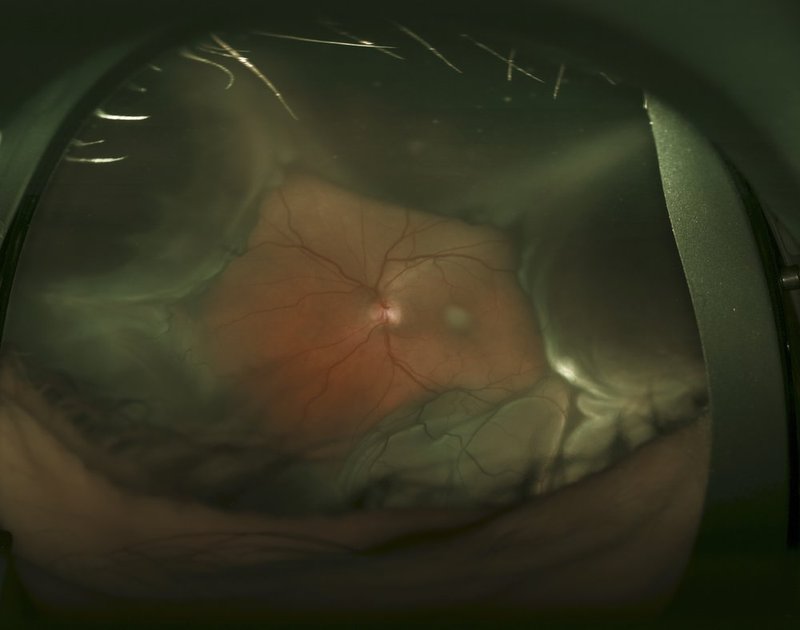 Choroidal Detachment.jpg