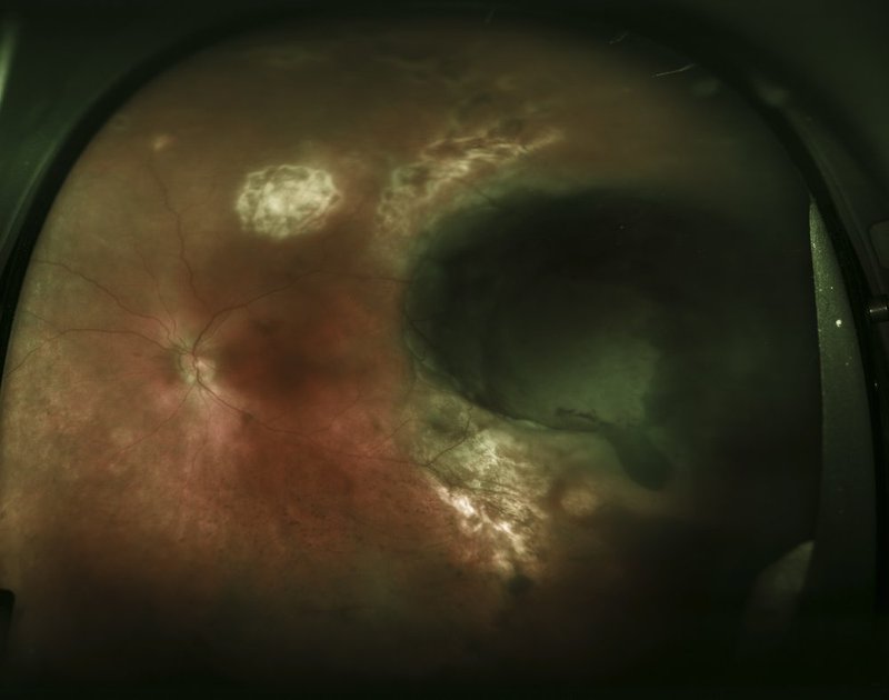 Choroidal melanoma.jpg