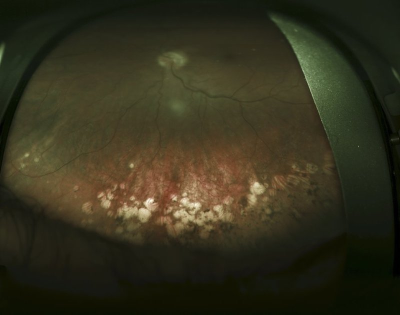 Cobblestone Degeneration.jpg