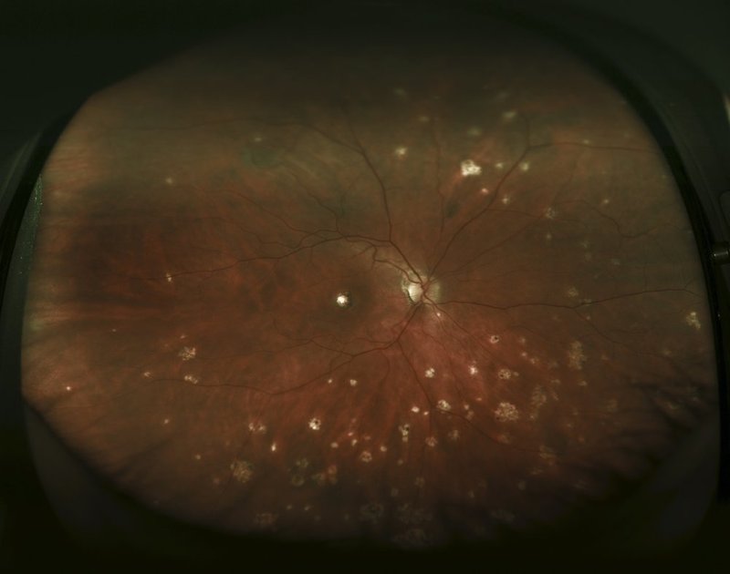 Disseminated choiroretinitis  MFC.jpg