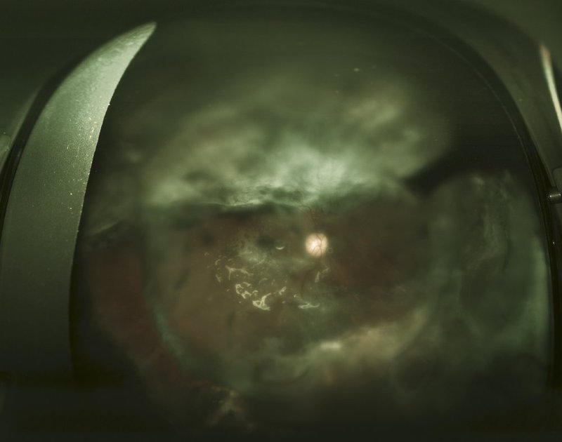 HIV AIDS CMV retinitis.jpg