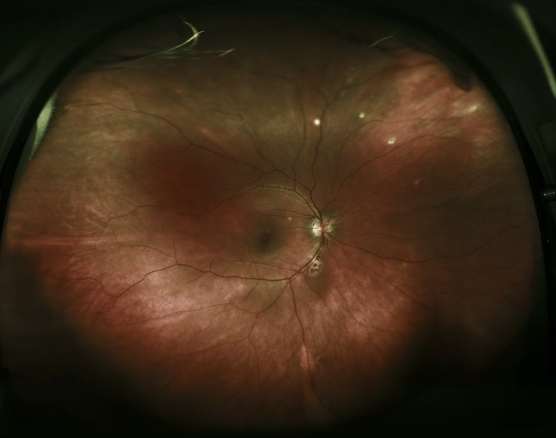 POHS Histoplasmosis.jpg