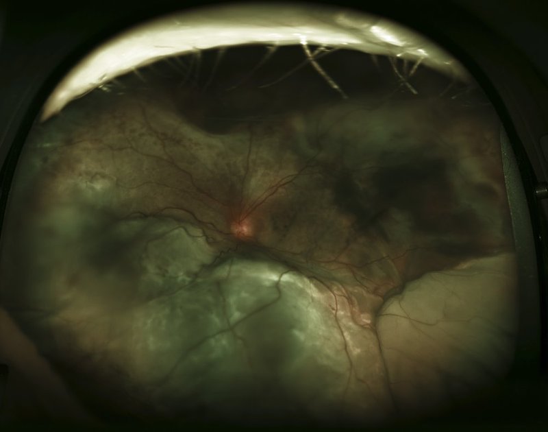 Retinal Detachment 2.jpg