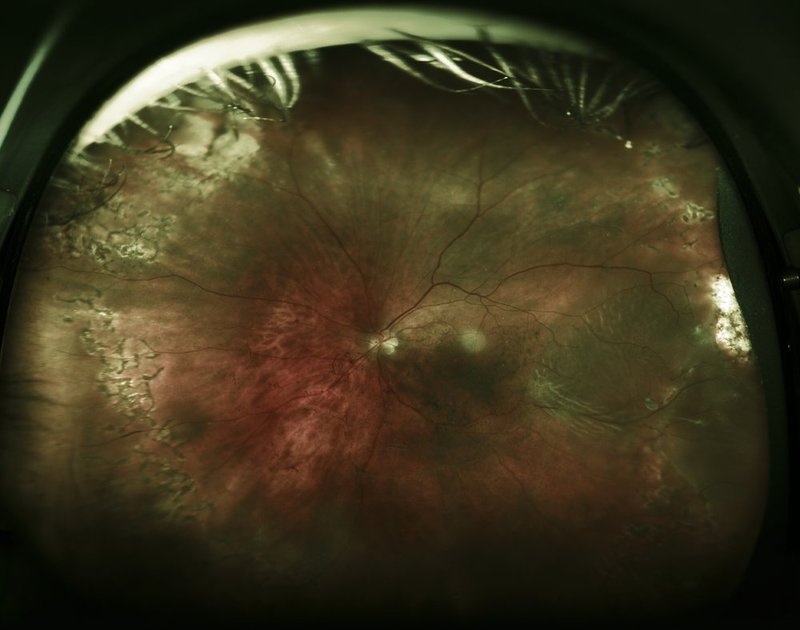 Retinal Detachment 3.jpg
