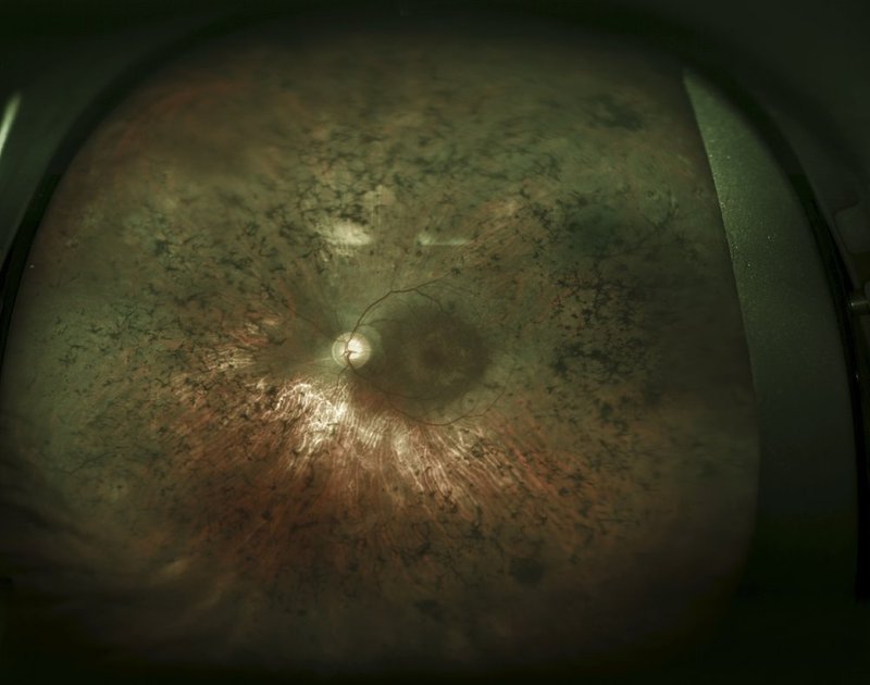 Retinitis Pigmentosa.jpg