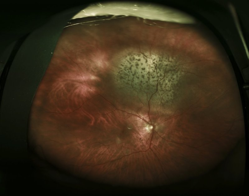 malignant neoplasm of Choroid.jpg
