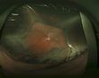 Choroidal Detachment.jpg