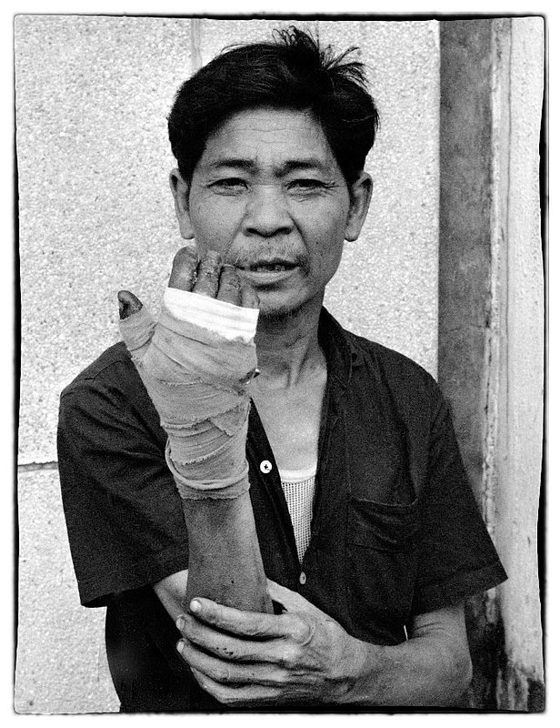 Injury.jpg :: This gentleman received an injury to his hand,fingers and wrist, I dont know how, motioned to me when he seen my camera and held his arm up. 